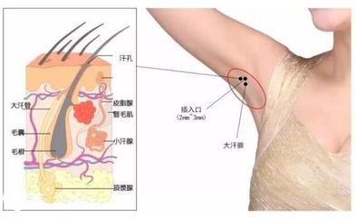 夏季有腋臭怎么办?深圳鹏程医院瘦脸除皱除腋臭仅980元!